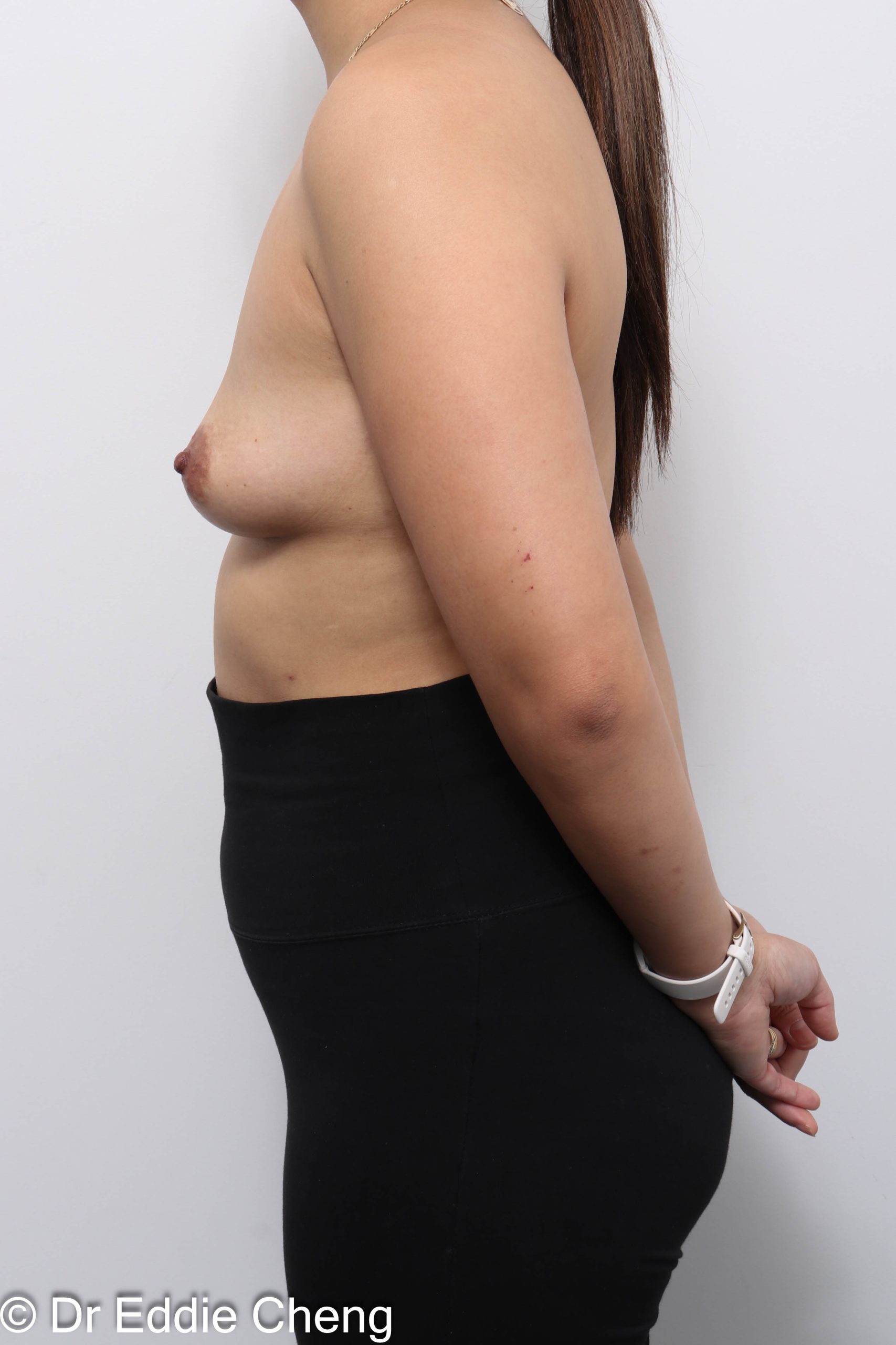 Before and after breast augmentation surgery by Dr Eddie Cheng, AR Plastic Surgery Brisbane