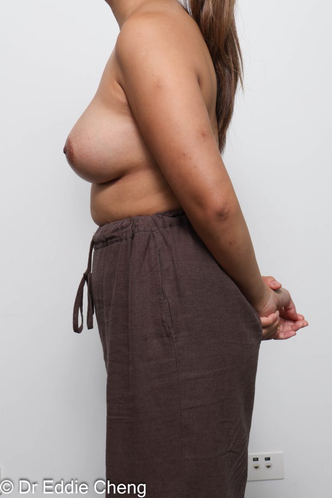 Before and after breast augmentation surgery by Dr Eddie Cheng, AR Plastic Surgery Brisbane