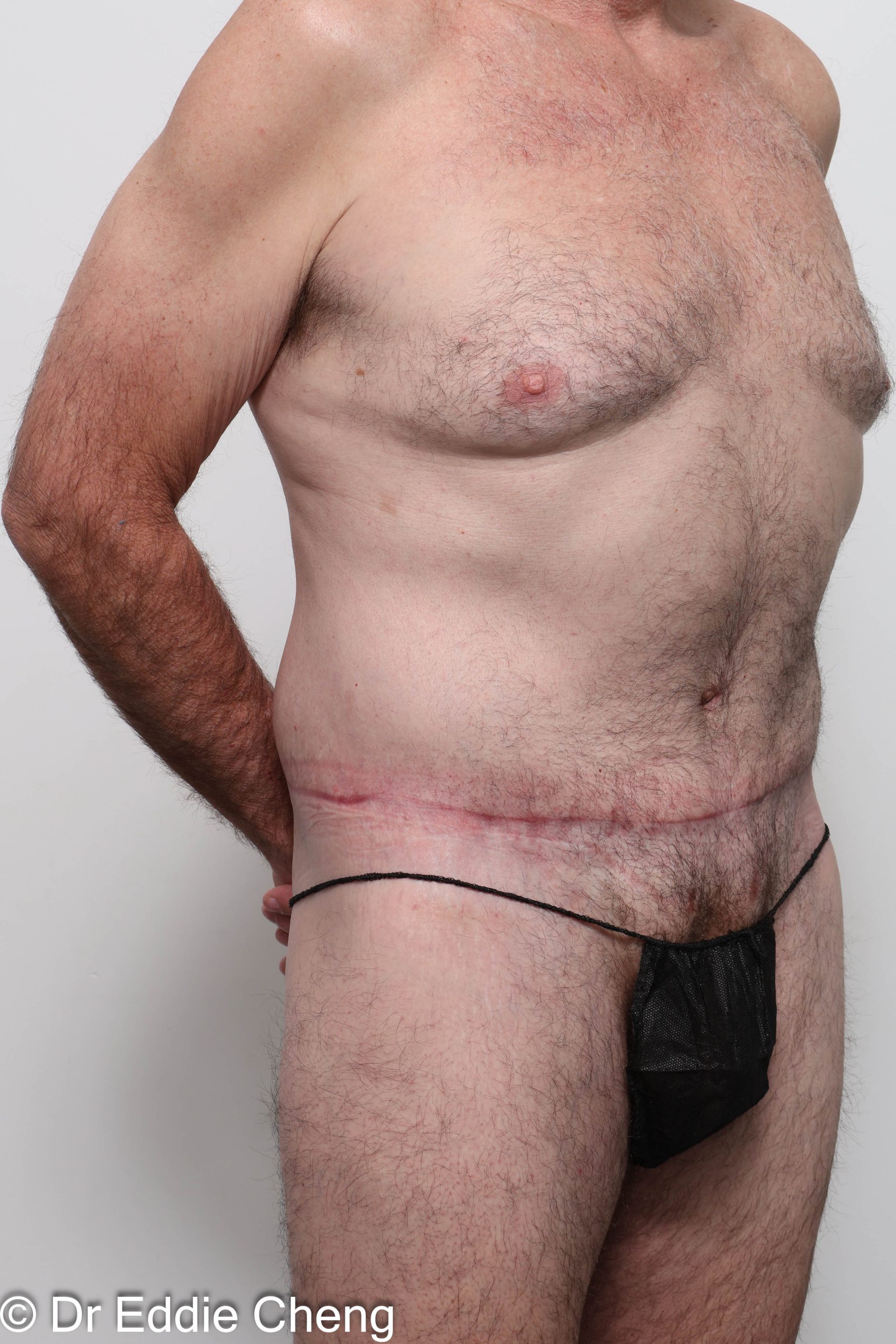 Before and after circumferential lipectomy surgery by Dr Eddie Cheng, AR Plastic Surgery Brisbane