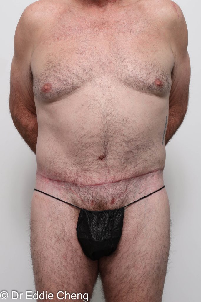 Before and after circumferential lipectomy surgery by Dr Eddie Cheng, AR Plastic Surgery Brisbane