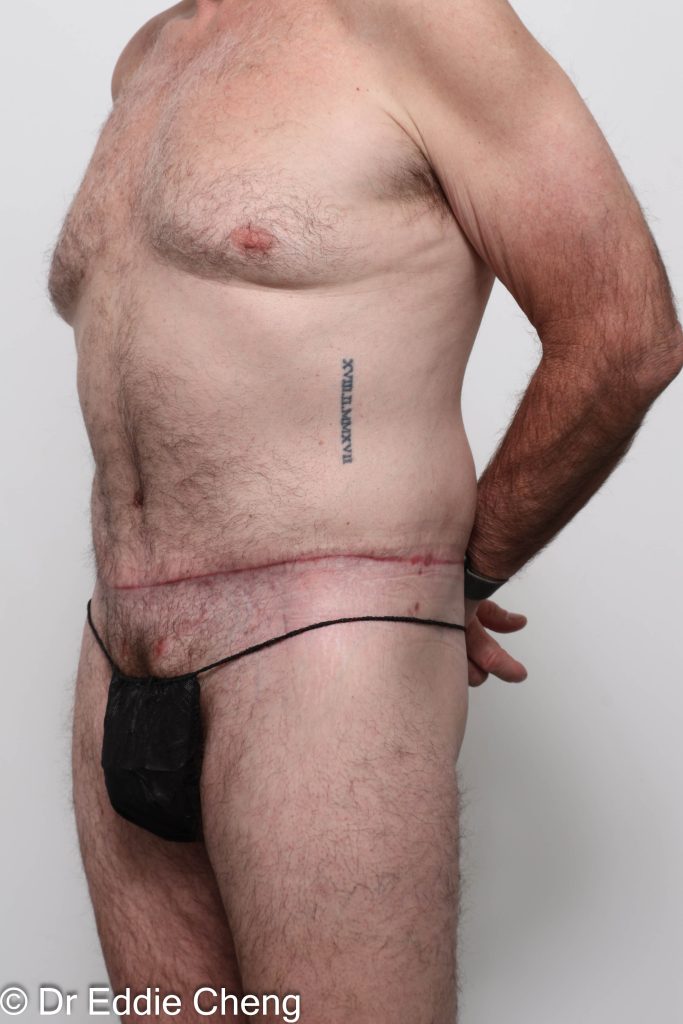 Before and after circumferential lipectomy surgery by Dr Eddie Cheng, AR Plastic Surgery Brisbane