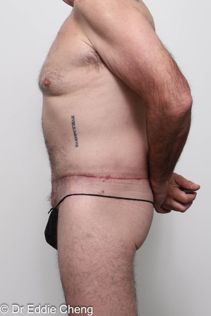 Before and after circumferential lipectomy surgery by Dr Eddie Cheng, AR Plastic Surgery Brisbane