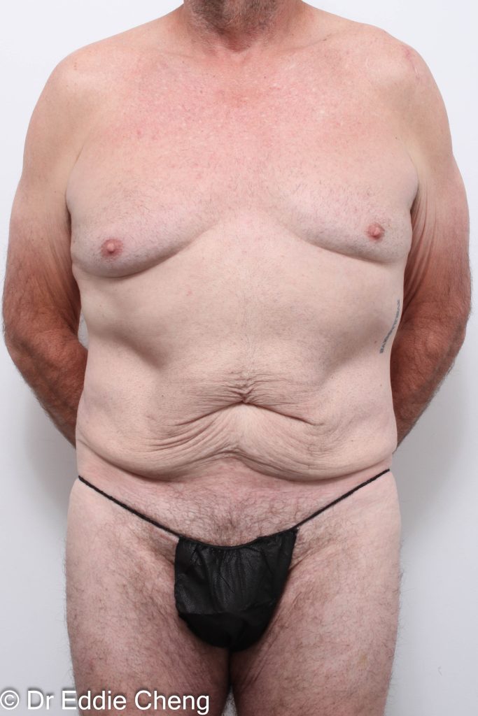 Before and after circumferential lipectomy surgery by Dr Eddie Cheng, AR Plastic Surgery Brisbane