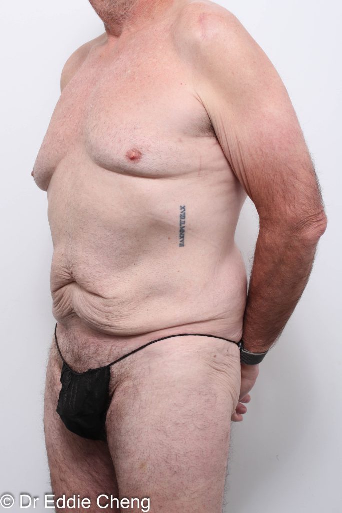 Before and after circumferential lipectomy surgery by Dr Eddie Cheng, AR Plastic Surgery Brisbane