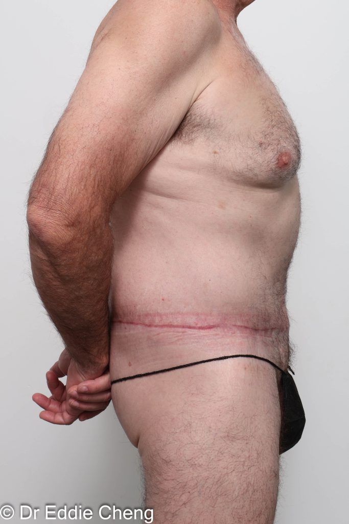 Before and after circumferential lipectomy surgery by Dr Eddie Cheng, AR Plastic Surgery Brisbane