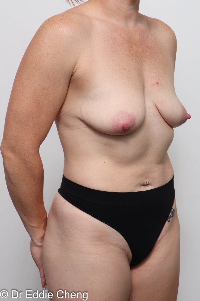 Before and after breast reduction surgery by Dr Eddie Cheng, AR Plastic Surgery Brisbane