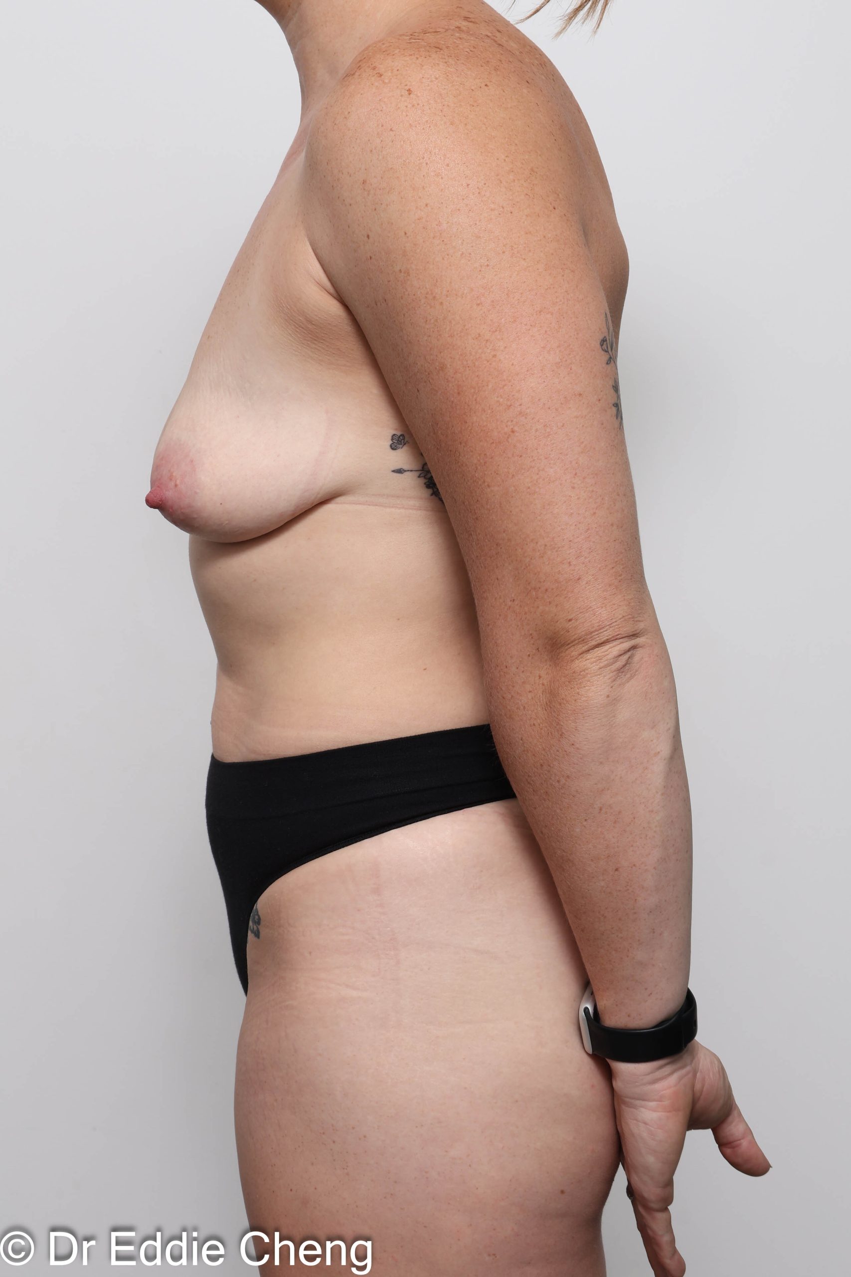 Before and after breast reduction surgery by Dr Eddie Cheng, AR Plastic Surgery Brisbane