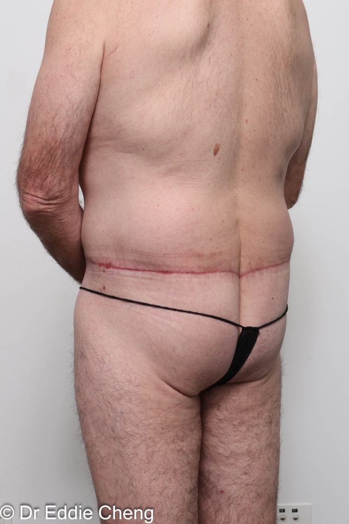 Before and after circumferential lipectomy surgery by Dr Eddie Cheng, AR Plastic Surgery Brisbane