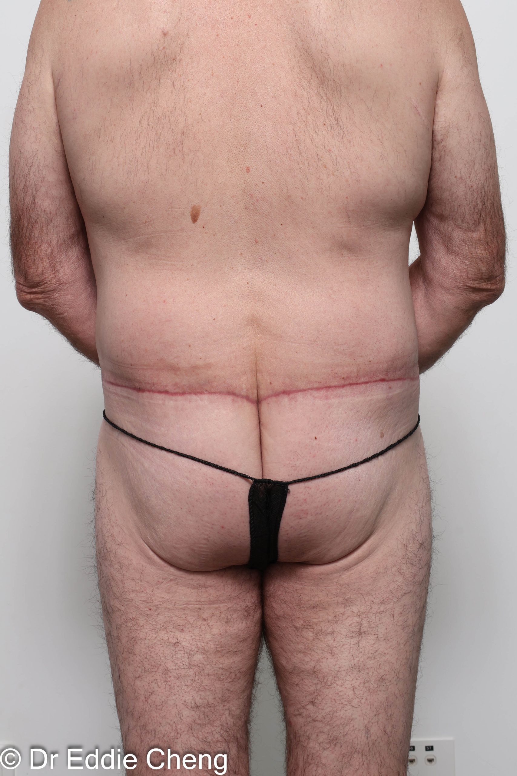Before and after circumferential lipectomy surgery by Dr Eddie Cheng, AR Plastic Surgery Brisbane