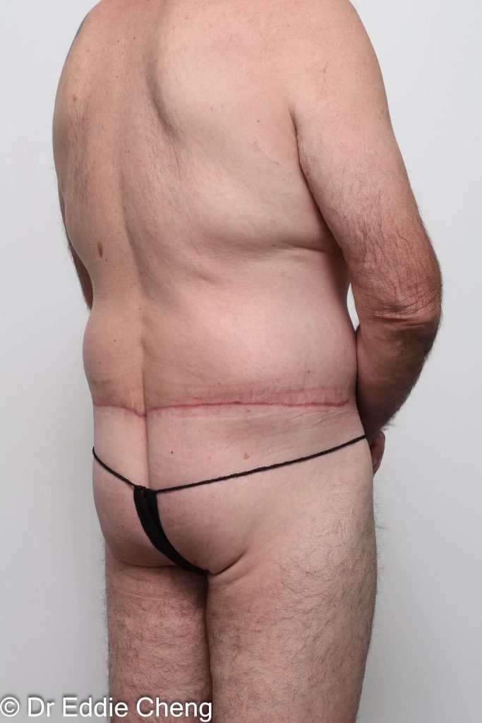 Before and after circumferential lipectomy surgery by Dr Eddie Cheng, AR Plastic Surgery Brisbane