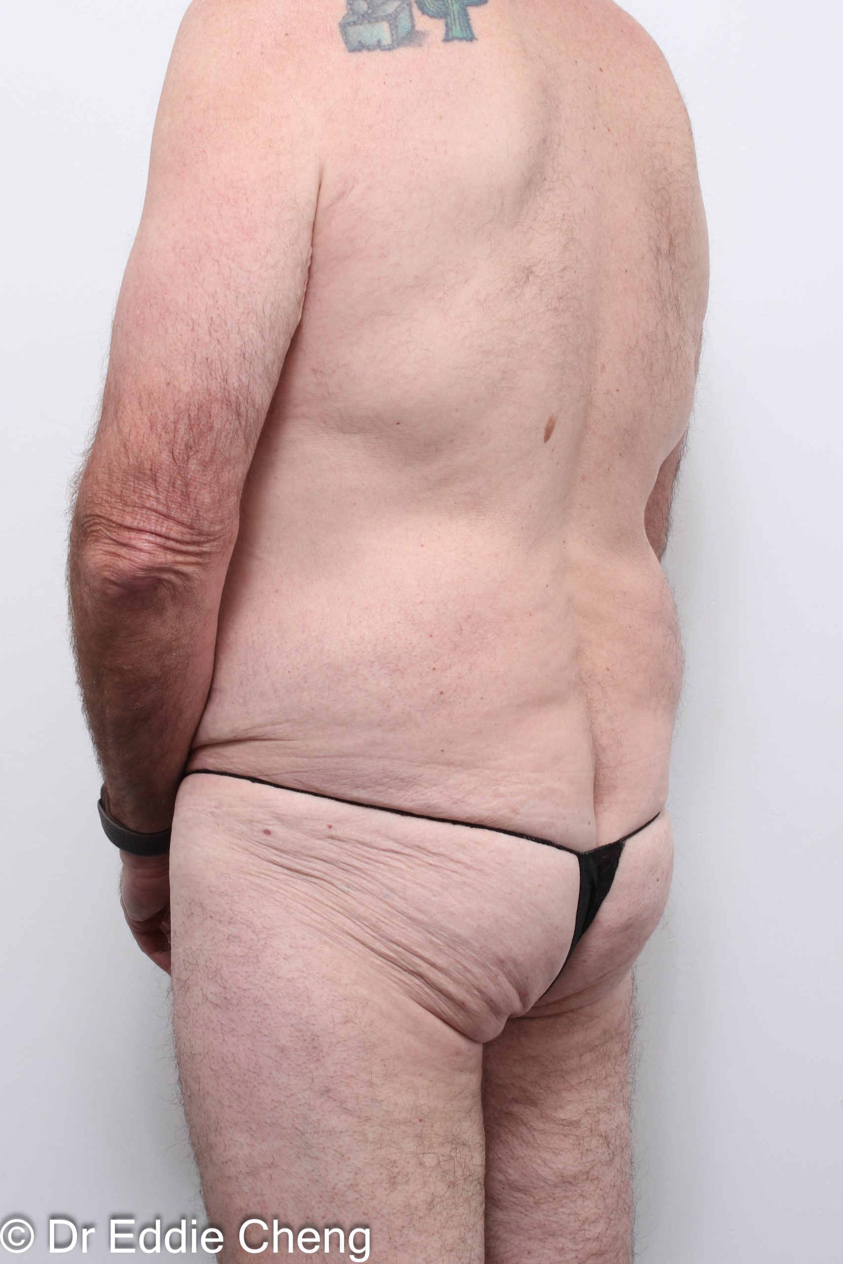 Before and after circumferential lipectomy surgery by Dr Eddie Cheng, AR Plastic Surgery Brisbane