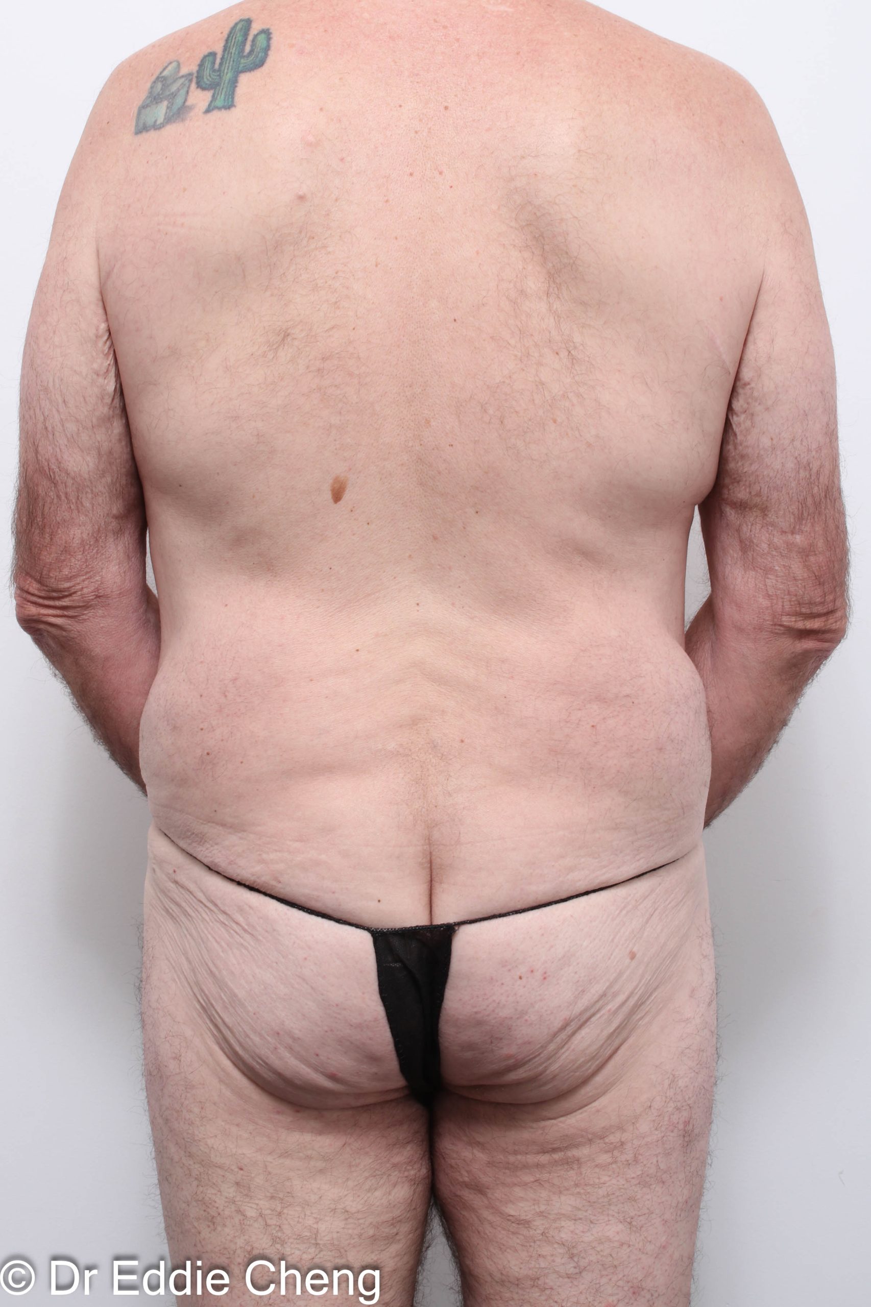 Before and after circumferential lipectomy surgery by Dr Eddie Cheng, AR Plastic Surgery Brisbane