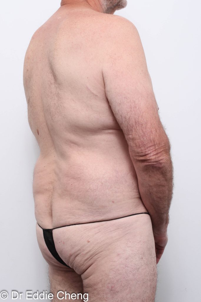 Before and after circumferential lipectomy surgery by Dr Eddie Cheng, AR Plastic Surgery Brisbane