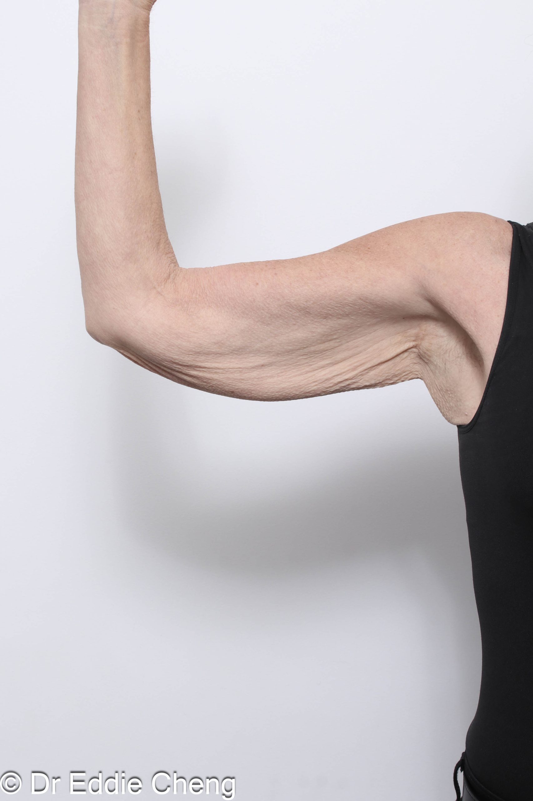 Before and after arm lipectomy surgery by Dr Eddie Cheng, AR Plastic Surgery Brisbane