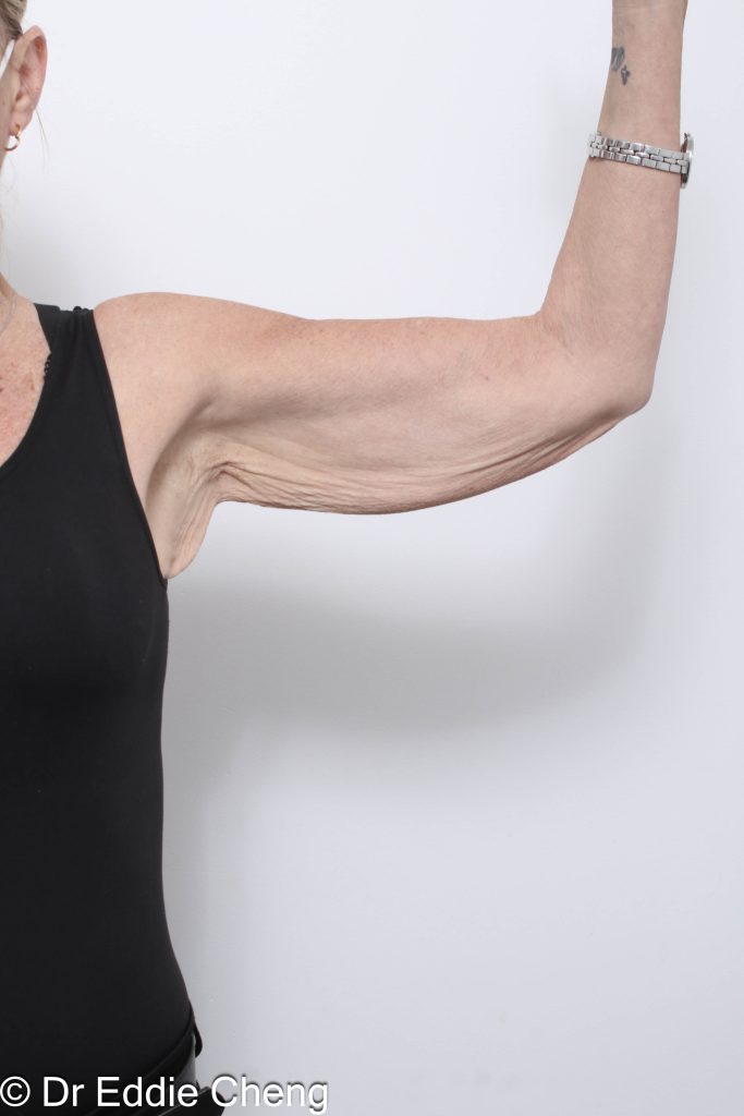 Before and after arm lipectomy surgery by Dr Eddie Cheng, AR Plastic Surgery Brisbane