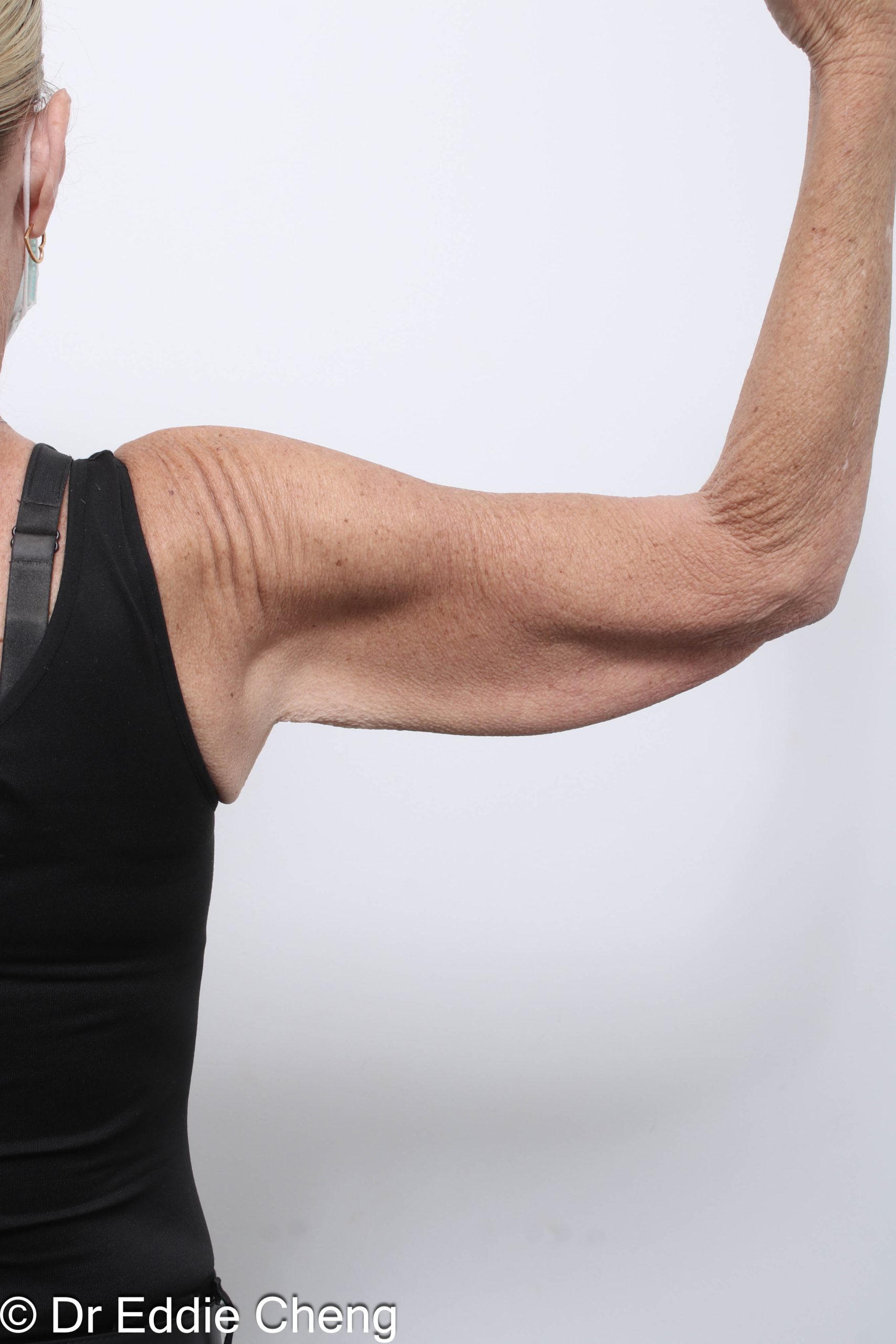 Before and after arm lipectomy surgery by Dr Eddie Cheng, AR Plastic Surgery Brisbane
