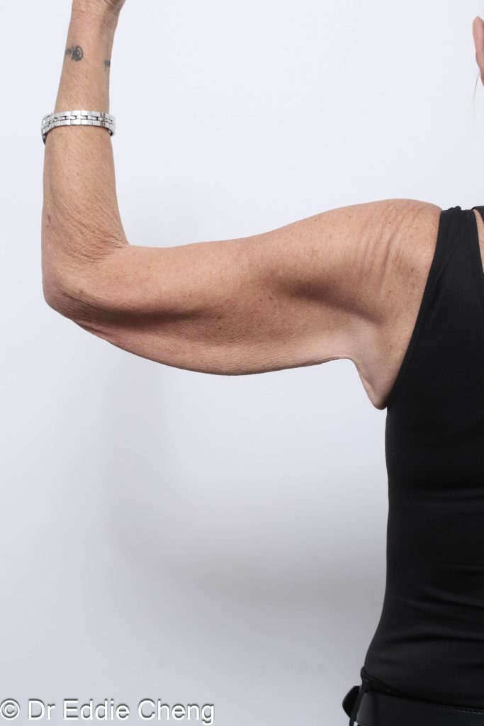 Before and after arm lipectomy surgery by Dr Eddie Cheng, AR Plastic Surgery Brisbane