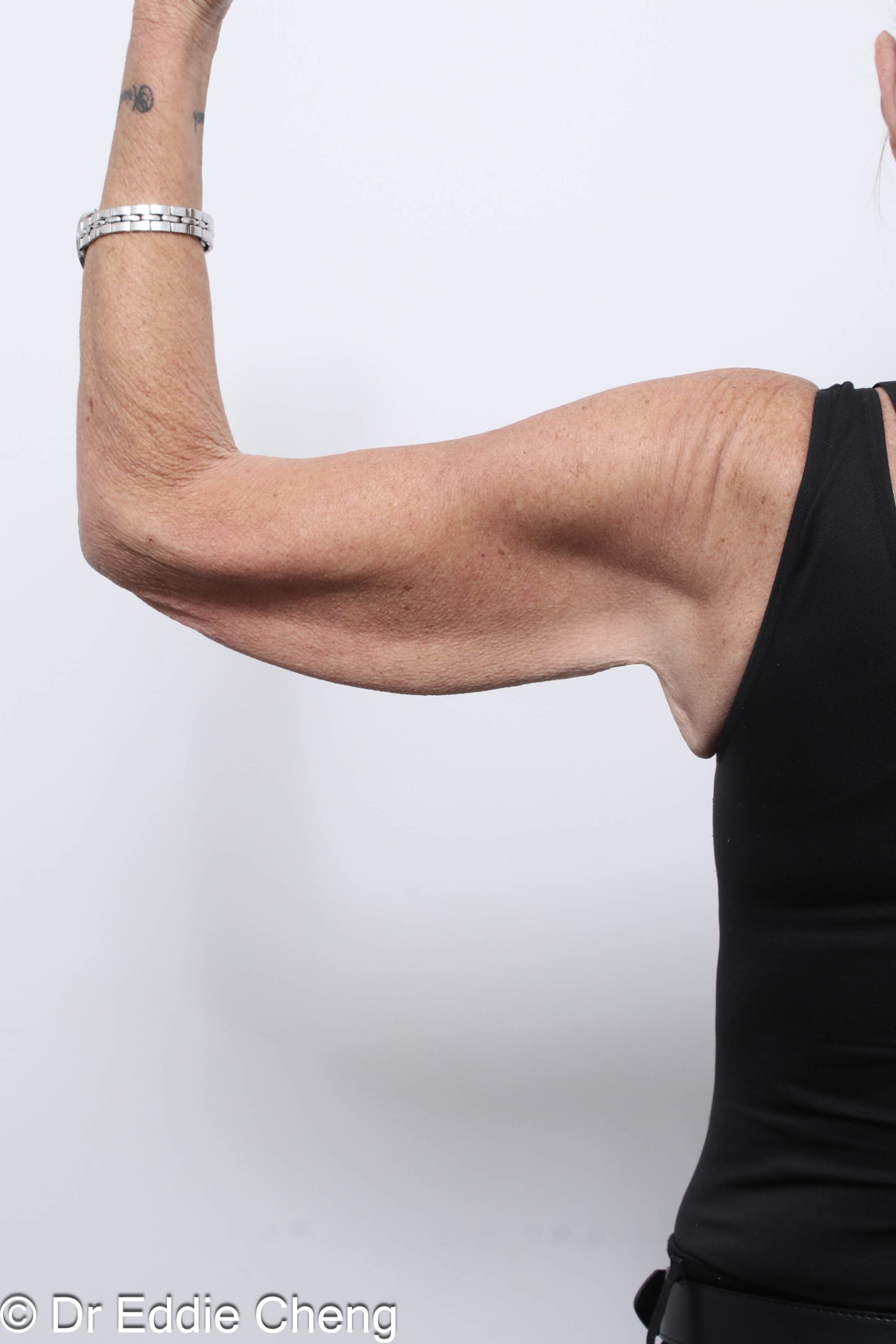 Before and after arm lipectomy surgery by Dr Eddie Cheng, AR Plastic Surgery Brisbane