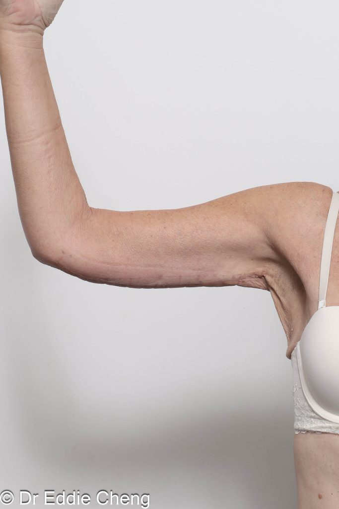 Before and after arm lipectomy surgery by Dr Eddie Cheng, AR Plastic Surgery Brisbane