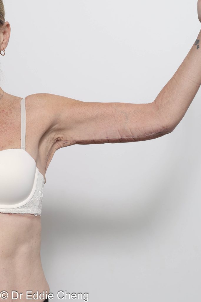 Before and after arm lipectomy surgery by Dr Eddie Cheng, AR Plastic Surgery Brisbane