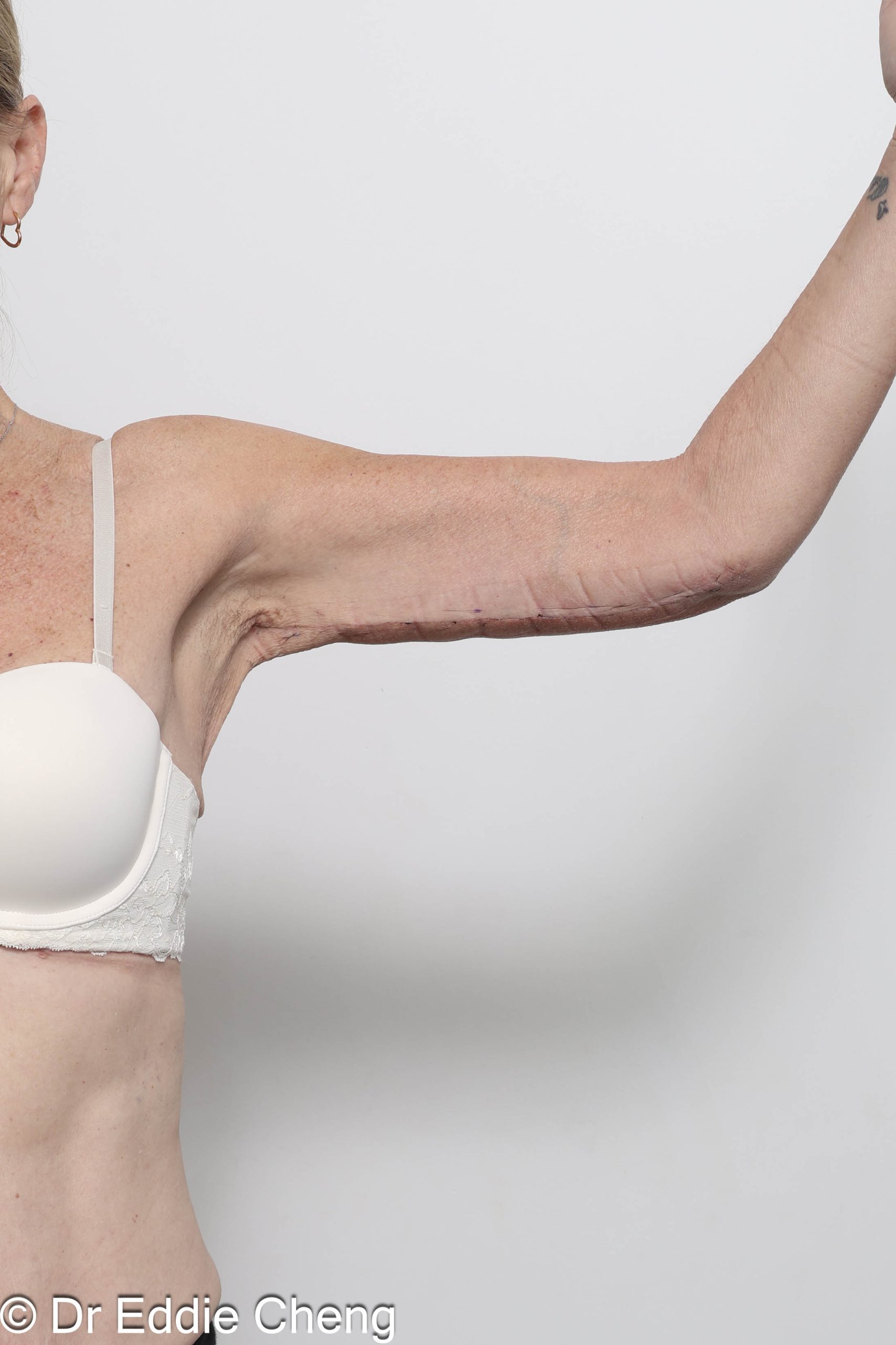 Before and after arm lipectomy surgery by Dr Eddie Cheng, AR Plastic Surgery Brisbane