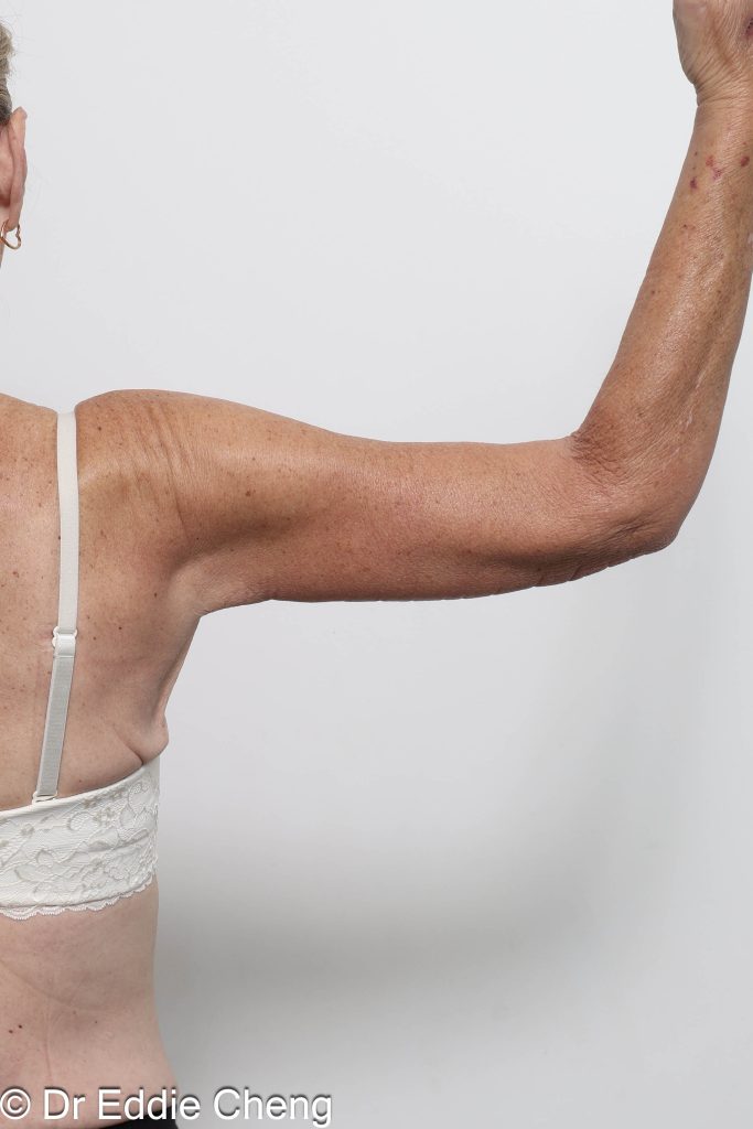 Before and after arm lipectomy surgery by Dr Eddie Cheng, AR Plastic Surgery Brisbane
