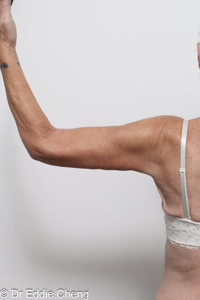 Before and after arm lipectomy or arm lift surgery by Dr Eddie Cheng, AR Plastic Surgery Brisbane