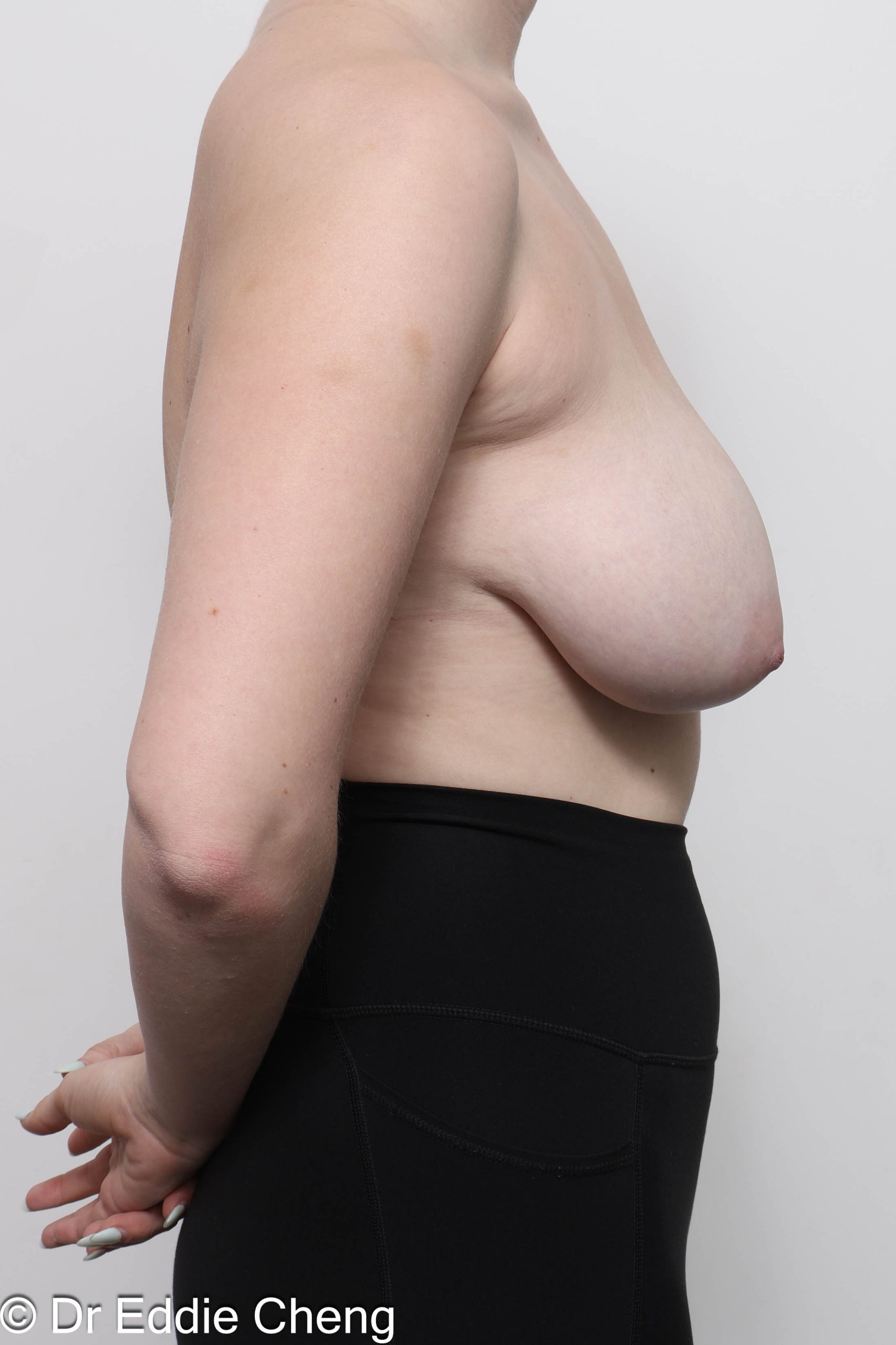 Before and after arm lipectomy surgery by Dr Eddie Cheng, AR Plastic Surgery Brisbane