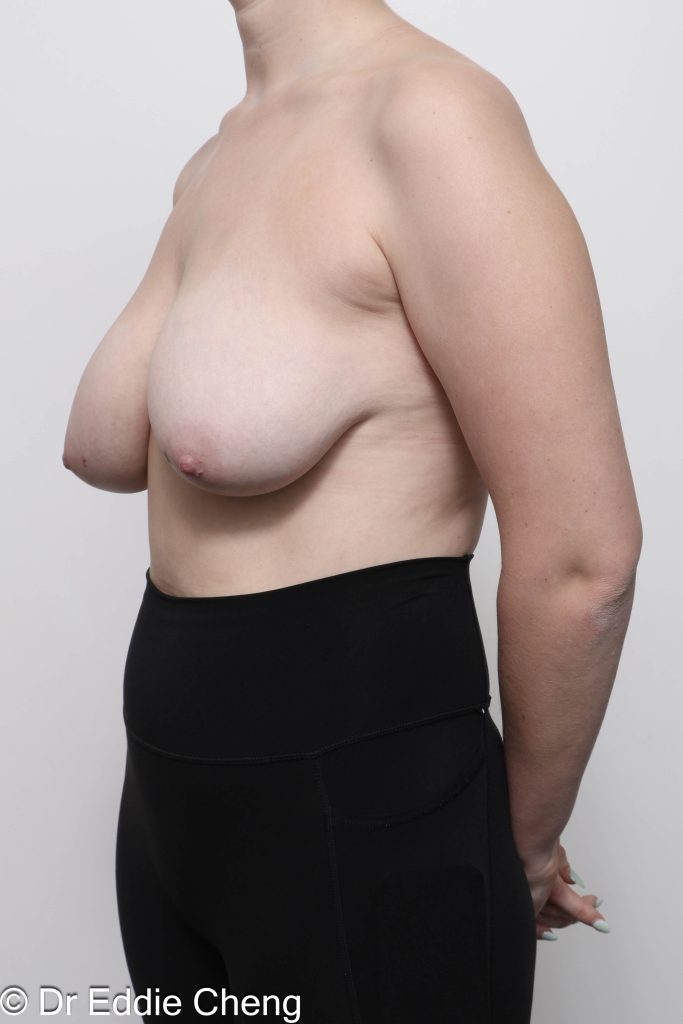 Before and after breast reduction surgery by Dr Eddie Cheng, AR Plastic Surgery Brisbane
