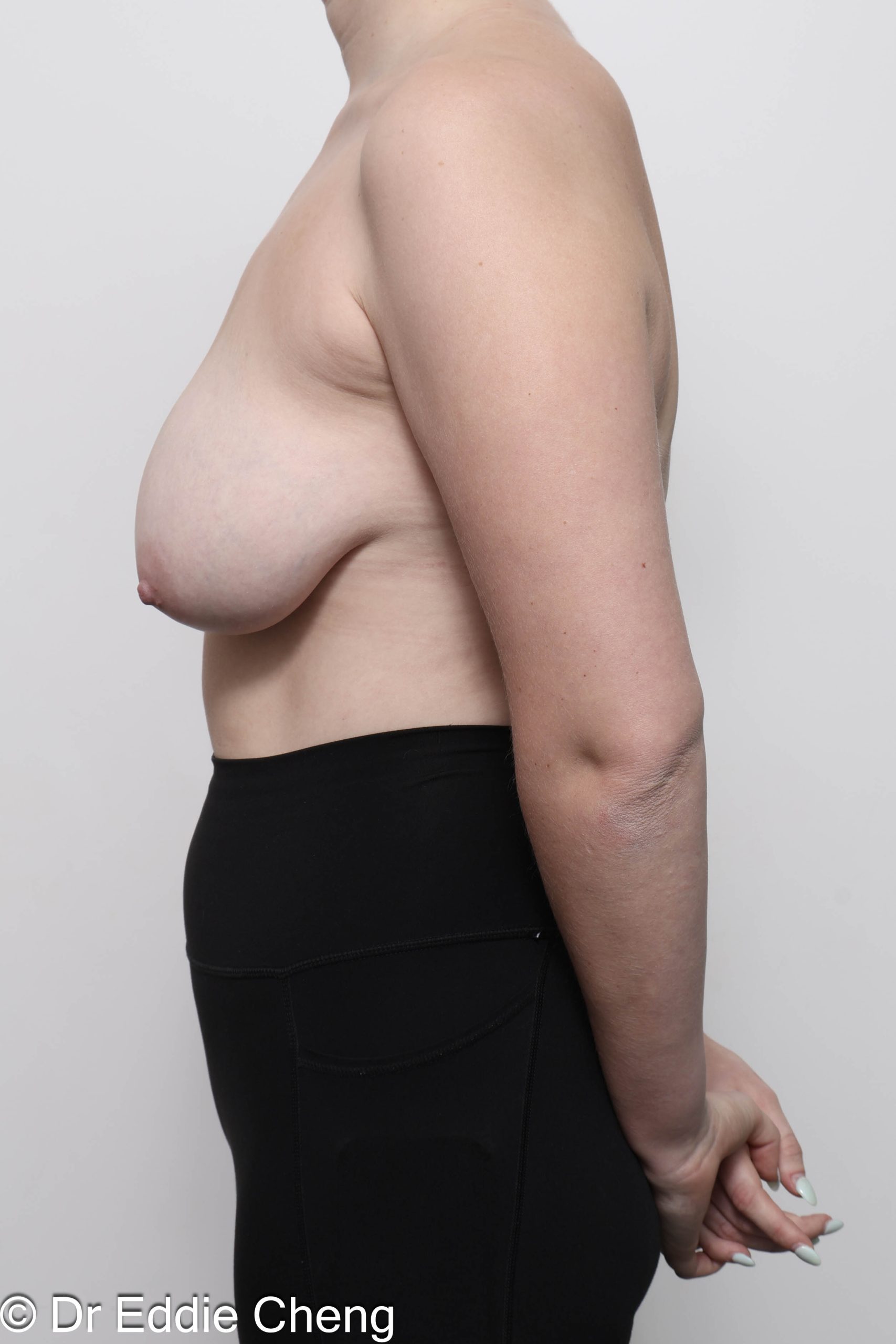 Before and after breast reduction surgery by Dr Eddie Cheng, AR Plastic Surgery Brisbane
