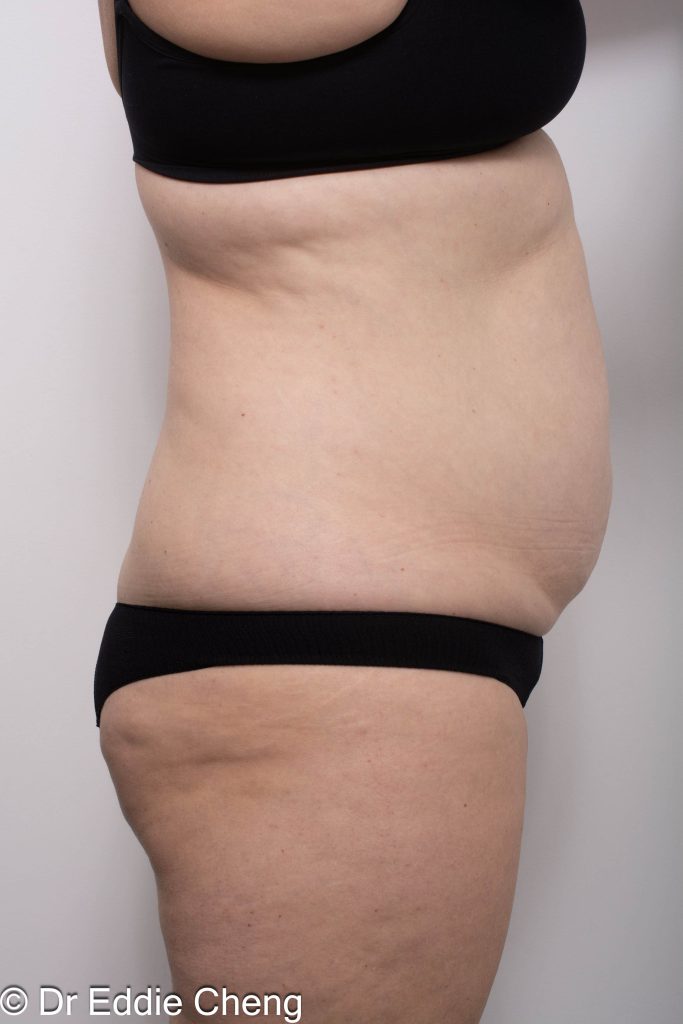 Before and after abdominoplasty surgery by Dr Eddie Cheng, AR Plastic Surgery Brisbane