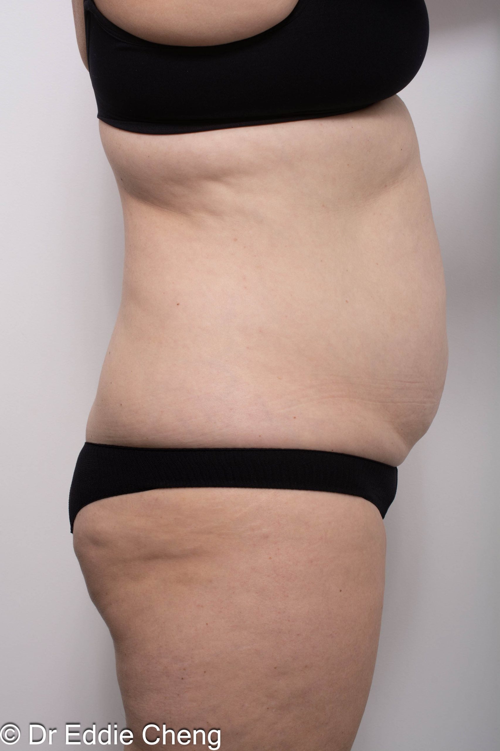 Before and after abdominoplasty surgery by Dr Eddie Cheng, AR Plastic Surgery Brisbane