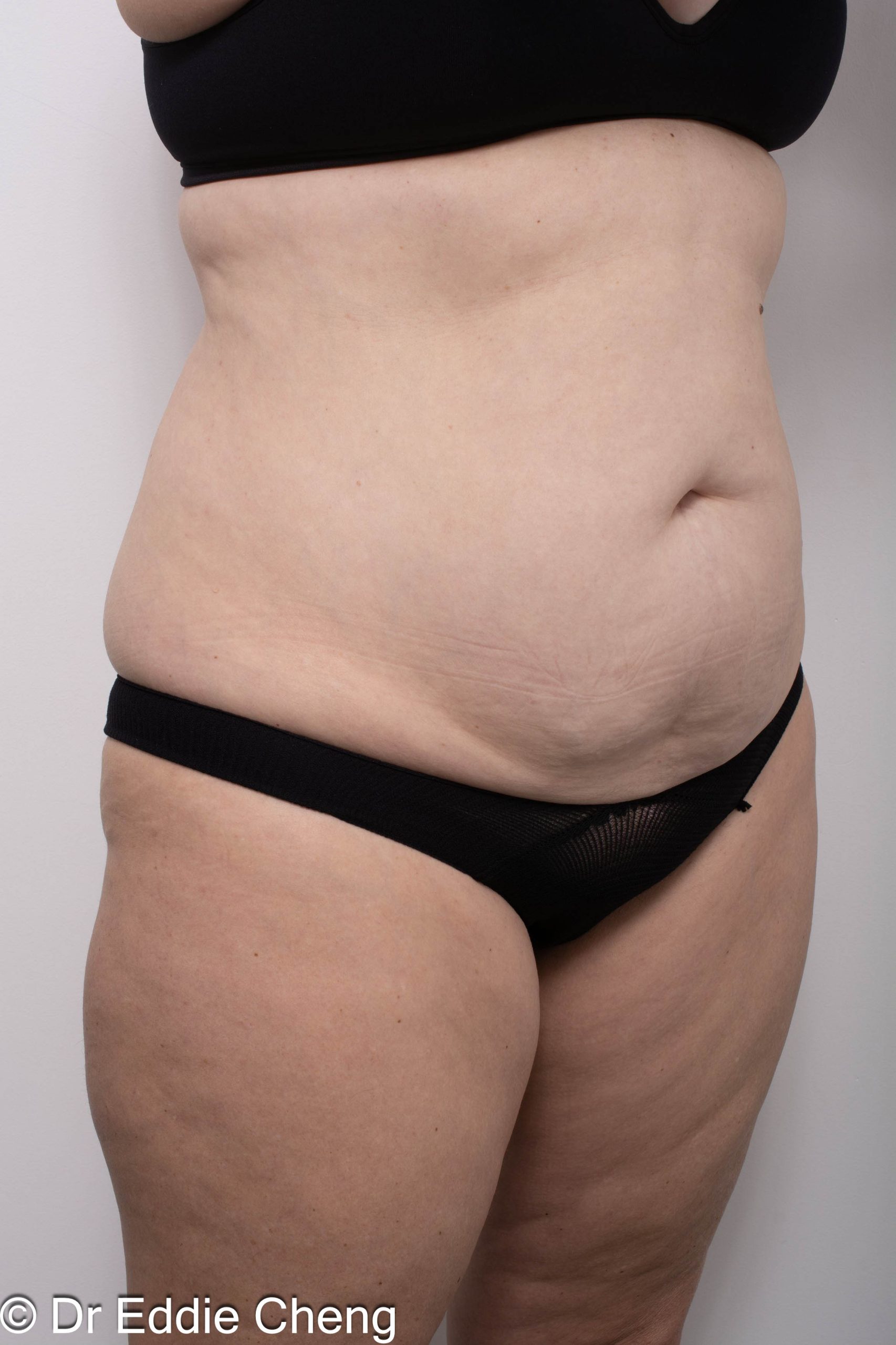 Before and after abdominoplasty surgery by Dr Eddie Cheng, AR Plastic Surgery Brisbane
