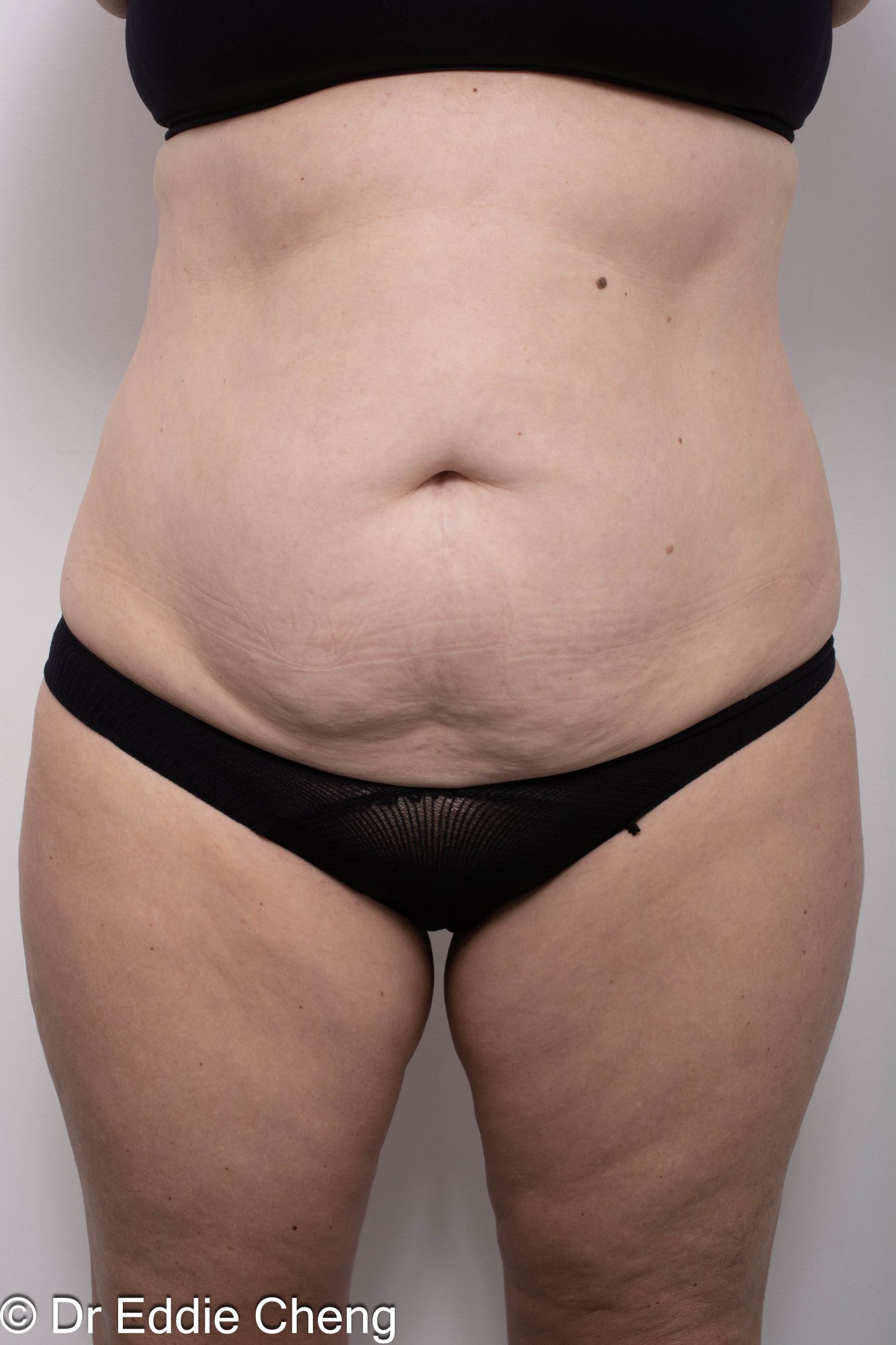Before and after abdominoplasty surgery by Dr Eddie Cheng, AR Plastic Surgery Brisbane