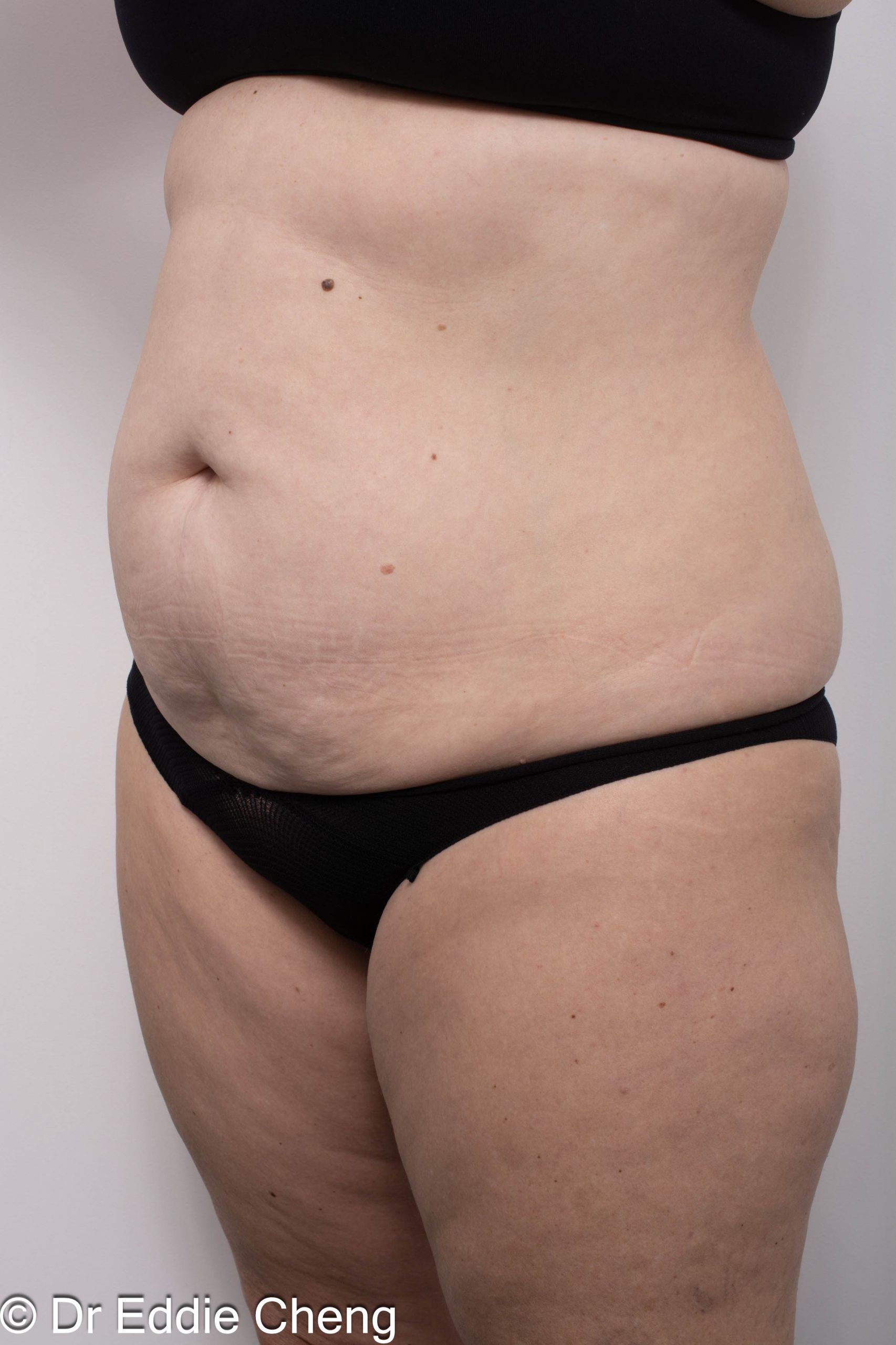 Before and after abdominoplasty surgery by Dr Eddie Cheng, AR Plastic Surgery Brisbane