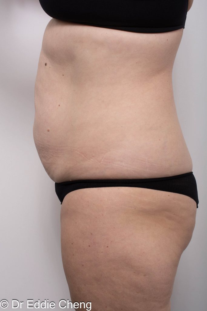 Before and after abdominoplasty surgery by Dr Eddie Cheng, AR Plastic Surgery Brisbane