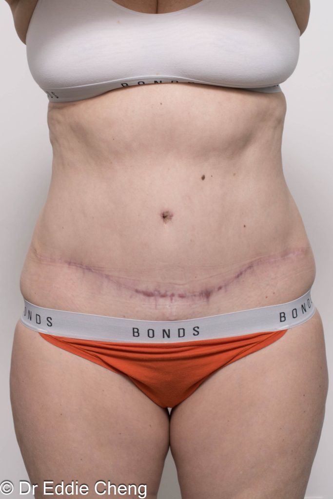 Before and after abdominoplasty surgery by Dr Eddie Cheng, AR Plastic Surgery Brisbane