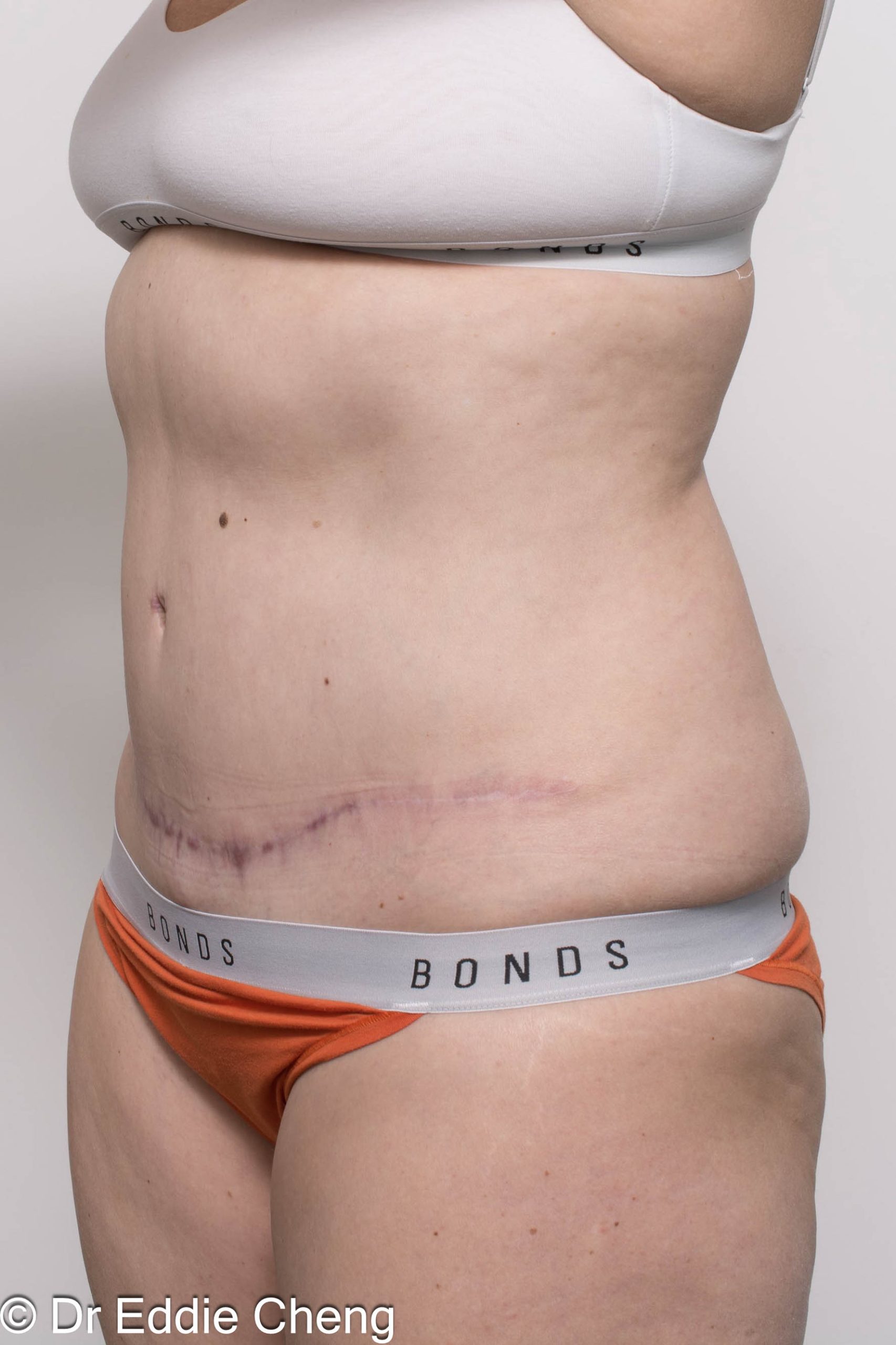 Before and after abdominoplasty surgery by Dr Eddie Cheng, AR Plastic Surgery Brisbane