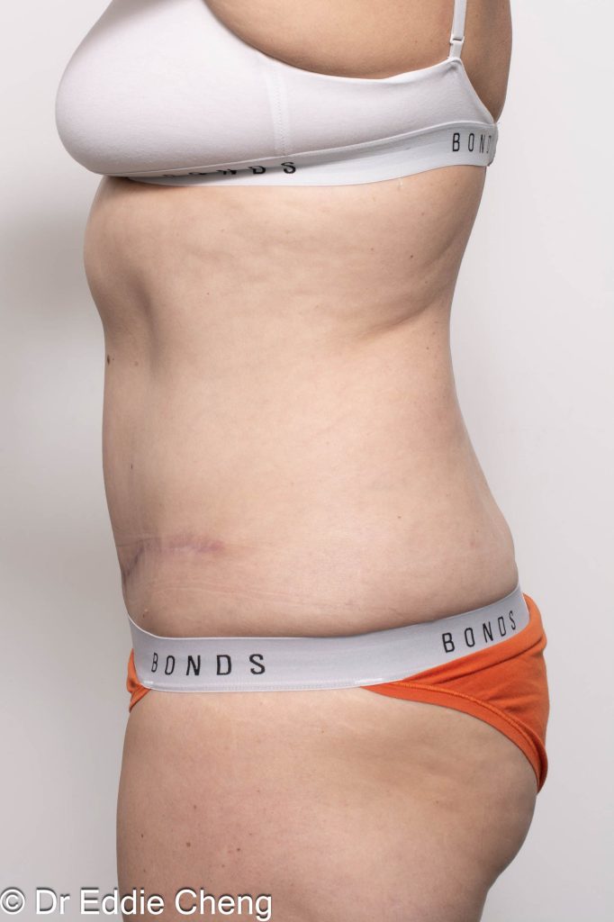 Before and after abdominoplasty surgery by Dr Eddie Cheng, AR Plastic Surgery Brisbane