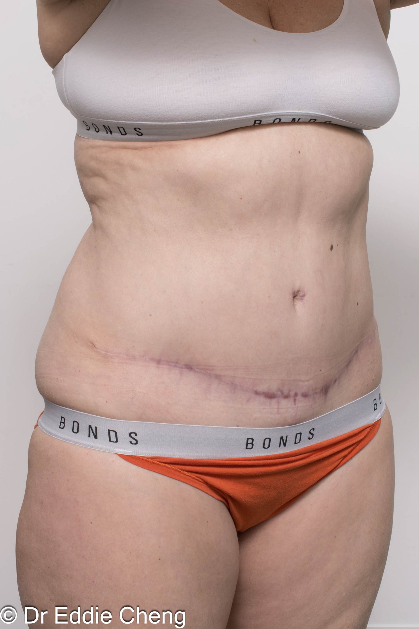 Before and after abdominoplasty surgery by Dr Eddie Cheng, AR Plastic Surgery Brisbane