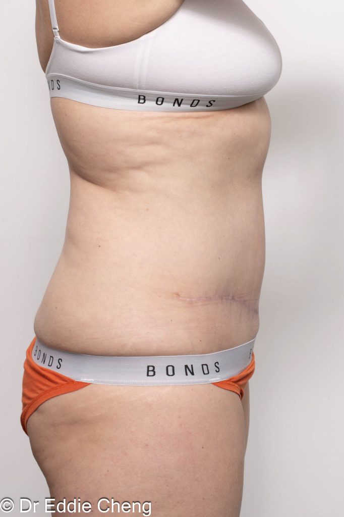 Before and after abdominoplasty surgery by Dr Eddie Cheng, AR Plastic Surgery Brisbane
