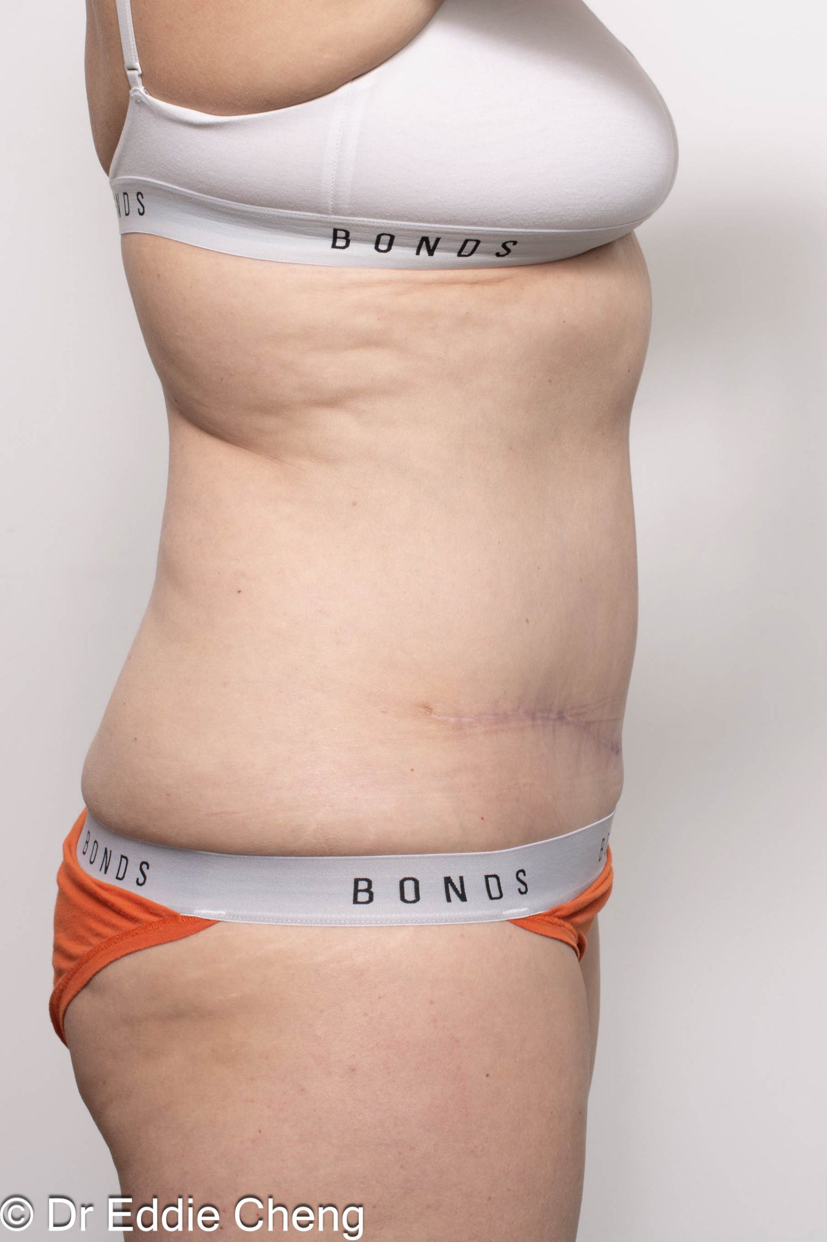 Before and after abdominoplasty surgery by Dr Eddie Cheng, AR Plastic Surgery Brisbane