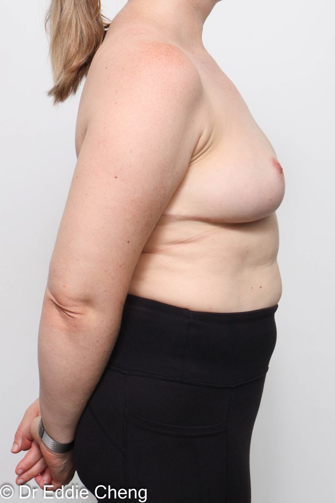 Before and after breast reduction surgery by Dr Eddie Cheng, AR Plastic Surgery Brisbane
