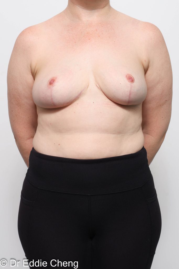 Before and after breast reduction surgery by Dr Eddie Cheng, AR Plastic Surgery Brisbane