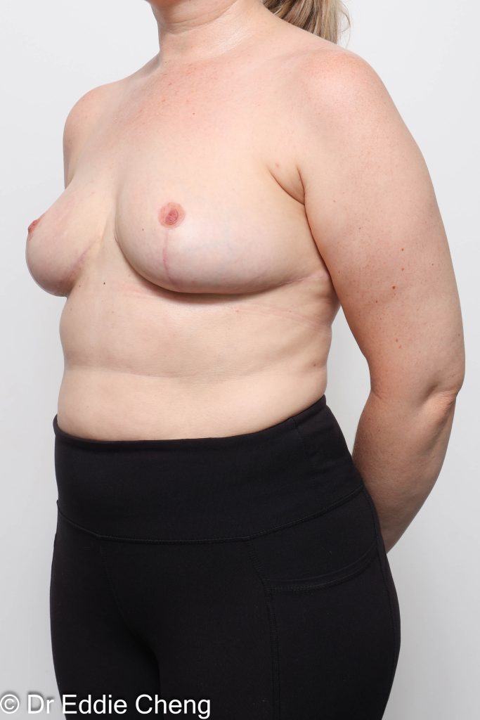 Before and after breast reduction surgery by Dr Eddie Cheng, AR Plastic Surgery Brisbane