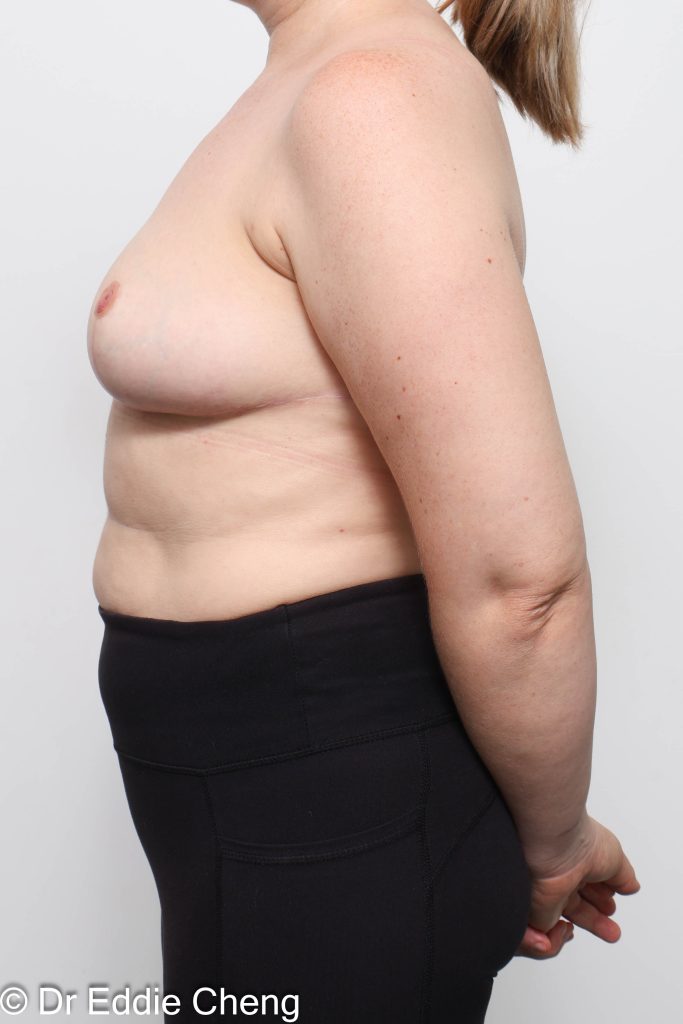 Before and after breast reduction surgery by Dr Eddie Cheng, AR Plastic Surgery Brisbane