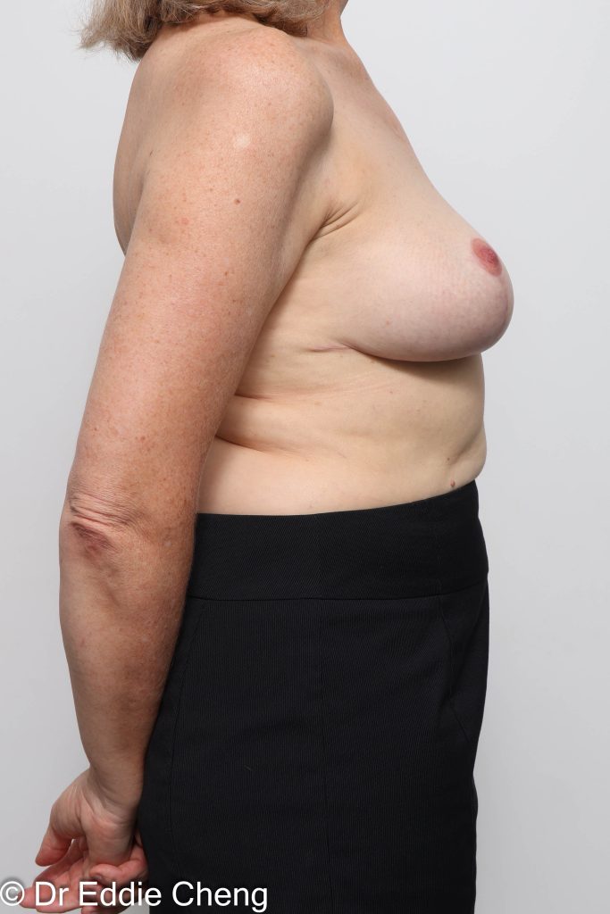 Before and after breast reduction surgery by Dr Eddie Cheng, AR Plastic Surgery Brisbane