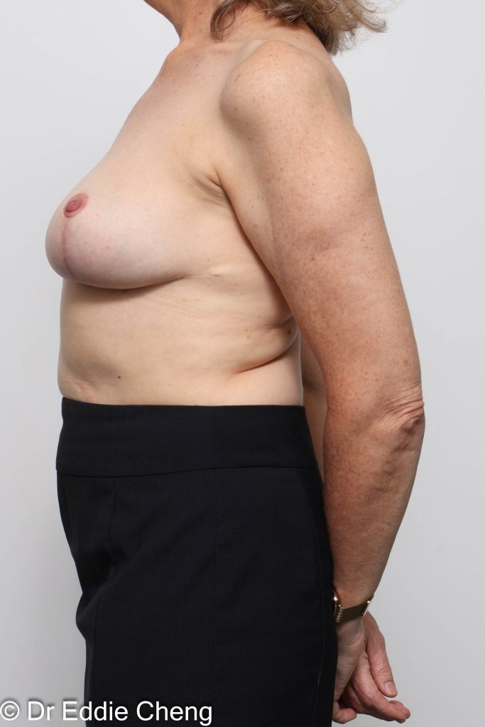 Before and after breast reduction surgery by Dr Eddie Cheng, AR Plastic Surgery Brisbane