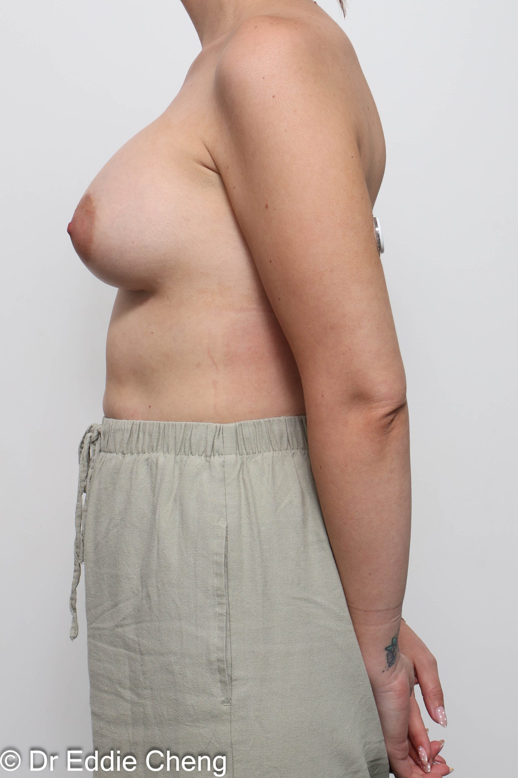 Before and after breast augmentation surgery by Dr Eddie Cheng, AR Plastic Surgery Brisbane