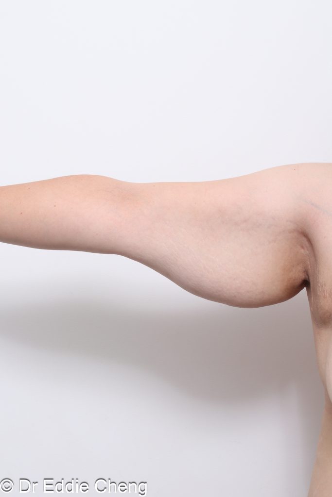 Before and after arm lift (brachioplasty) by Dr Eddie Cheng Brisbane.